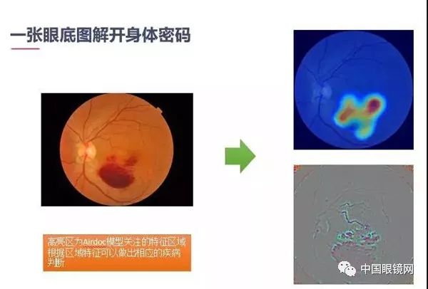 最新科研成果在治疗近视领域取得显著进展